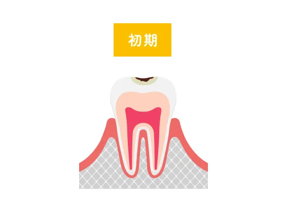 初期虫歯のイラスト