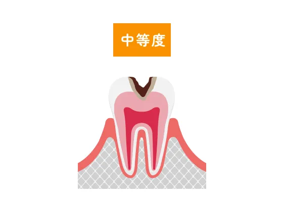 中等度の虫歯のイラスト