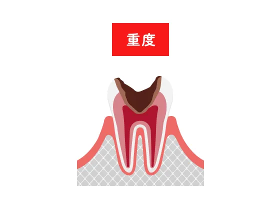 重度の虫歯のイラスト