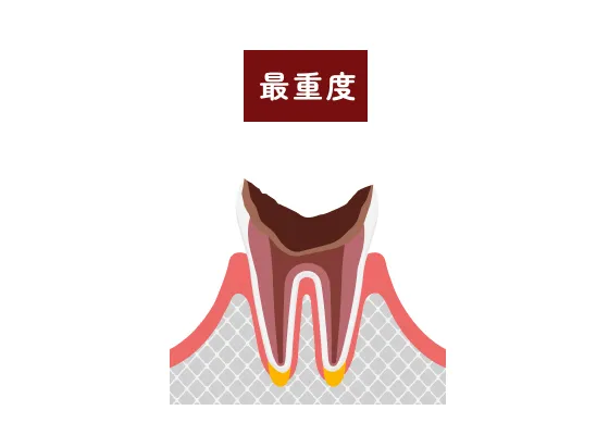 最重度の虫歯のイラスト